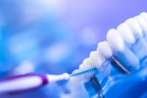 implantes dentales imagen
